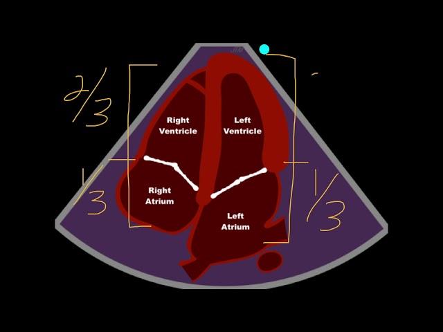 POCUS - Assessing Cardiac Chamber Size