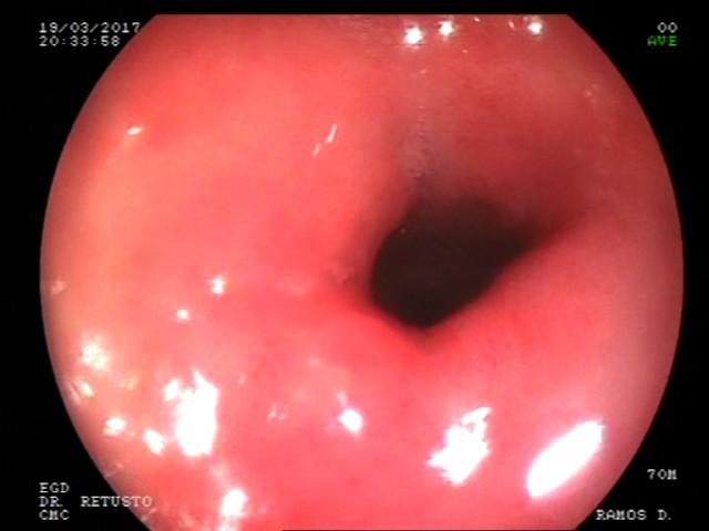 Endoscopy