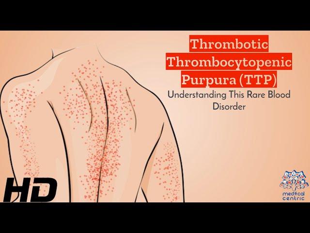 TTP Breakdown: A User-Friendly Guide to Thrombotic Thrombocytopenic Purpura