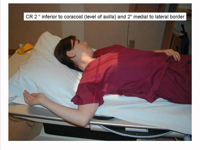 Scapula AP.wmv