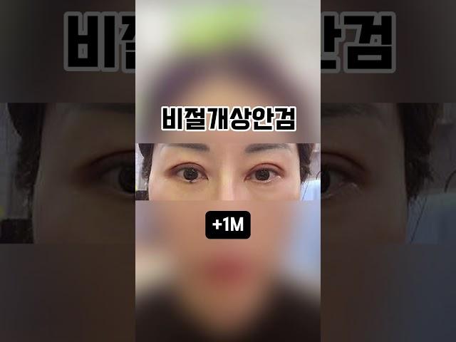 절개없이 처진 눈꺼풀 해결! 비절개상안검 3개월차 전후 비교