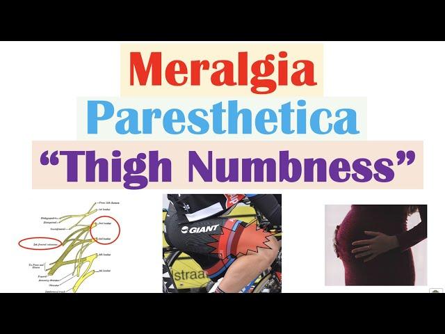 Meralgia Paresthetica (“Numbness of the Thigh”) | Causes, Symptoms, Diagnosis, Treatment