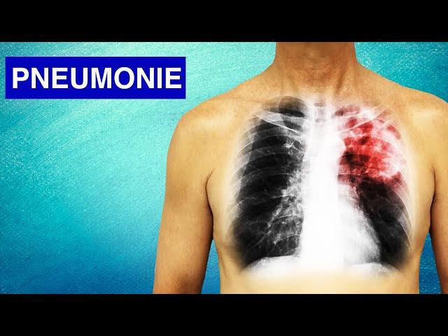 Pneumonie : Symptômes, Diagnostic et Traitements