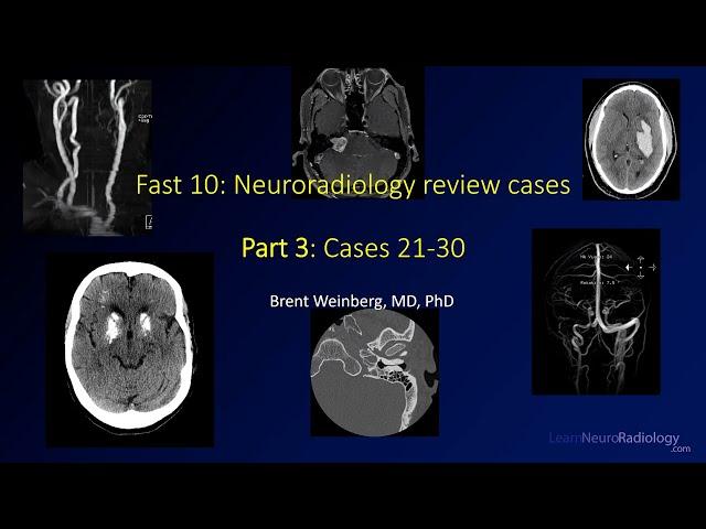 Fast 10: Neuroradiology high speed case review part 3 - Cases 21-30