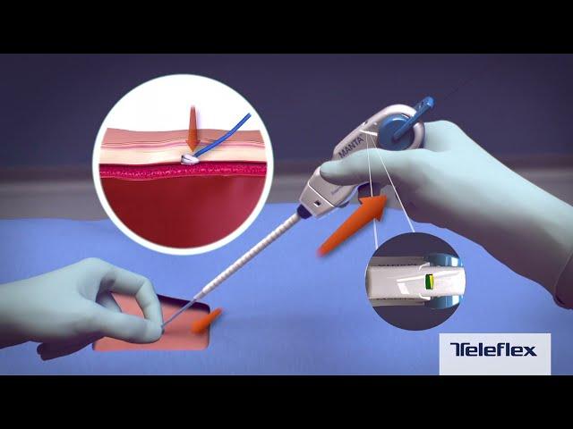 MANTA Vascular Closure Device Deployment