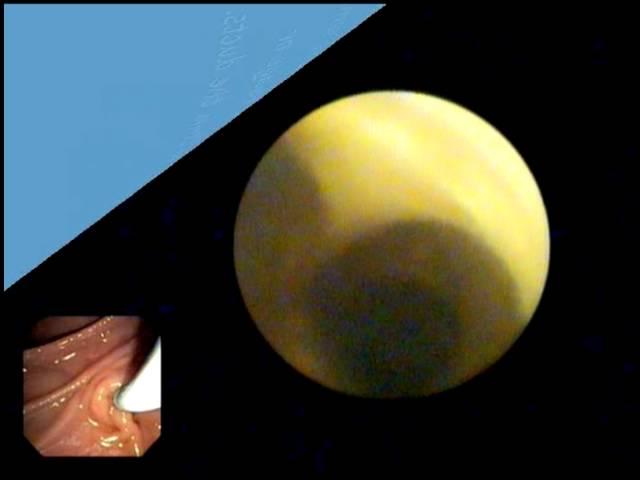 Direct Visualization of Normal Biliary Ducts with SpyGlass System, D Adler MD