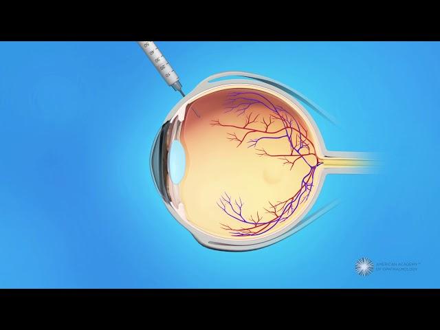 Eye Injections for Branch Retinal Vein Occlusion (BRVO)