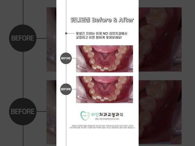 삐뚤한 #덧니 #교정치료 를 통해 환한 웃음을 되찾아보세요!