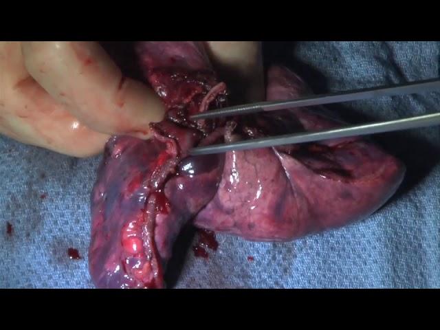 VATS Right Upper Lobectomy | Brigham and Women's Hospital