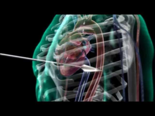 Arrow Through Human Heart - 3D Medical Animation || ABP ©