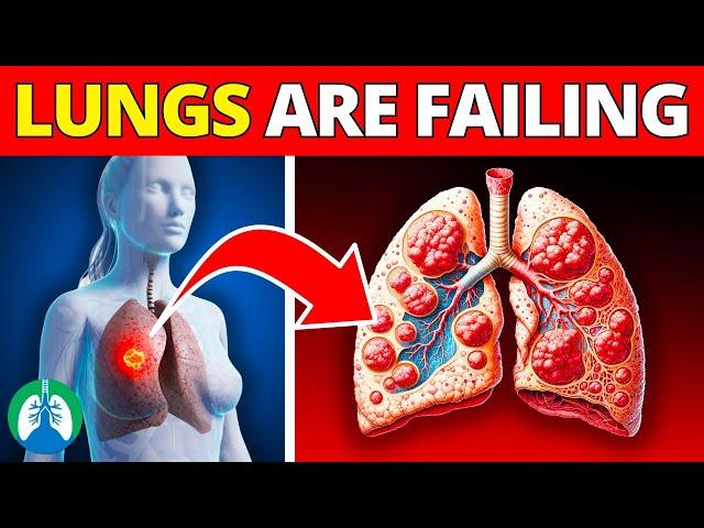 Pneumonia Early Warning Signs to NEVER Ignore