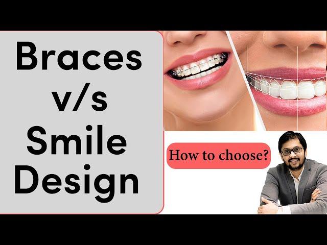 Braces vs Smile Design how to choose? | क्या चुने दोनों मे से? | Seraphic dental Indore