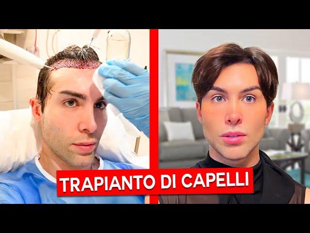 TRAPIANTO DI CAPELLI: LA MIA ESPERIENZA | GIANMARCO ZAGATO