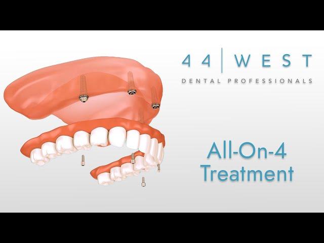 All-On-4 Implants | Grandville Dentist | 44 West Dental Professionals