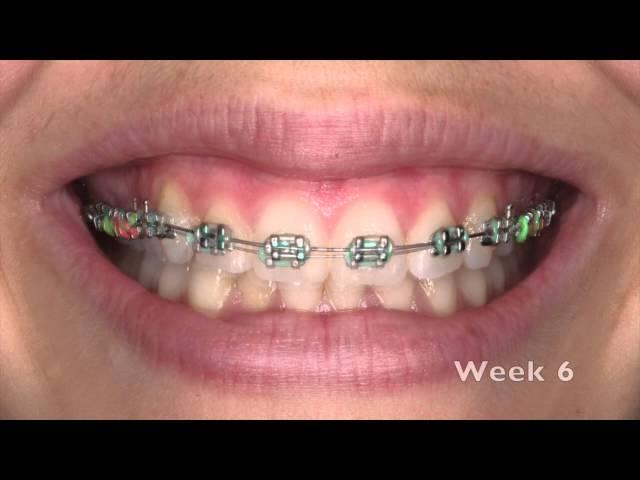 Emily's 10 weeks in braces