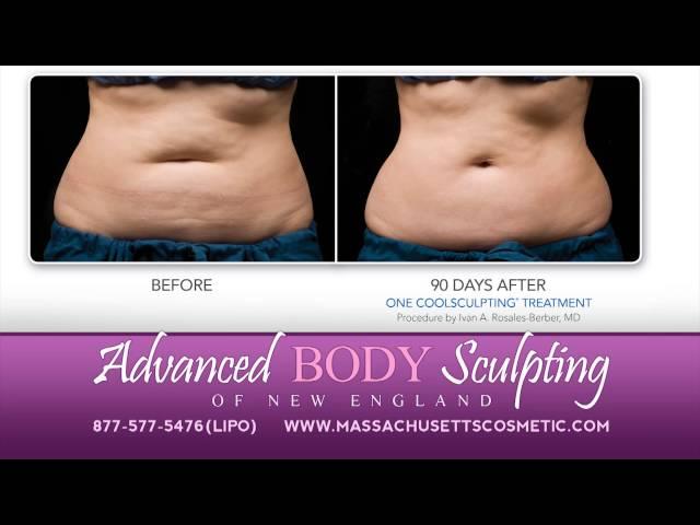 Advanced Body Sculpting - CoolSculpting - HD TV Commercial by Boyce Media