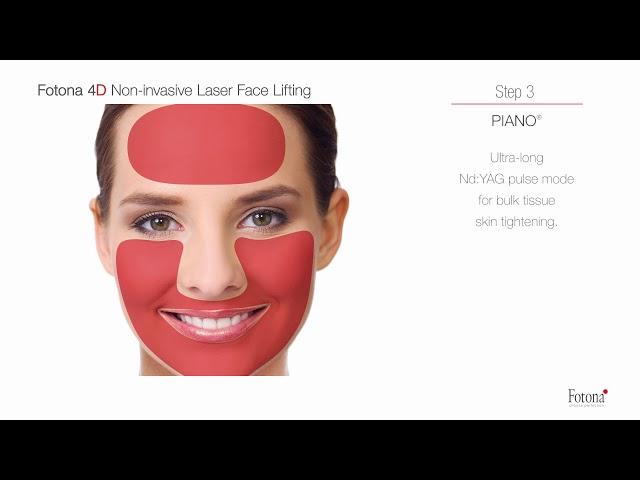 Fotona 4D Non-Invasive Laser Facelift