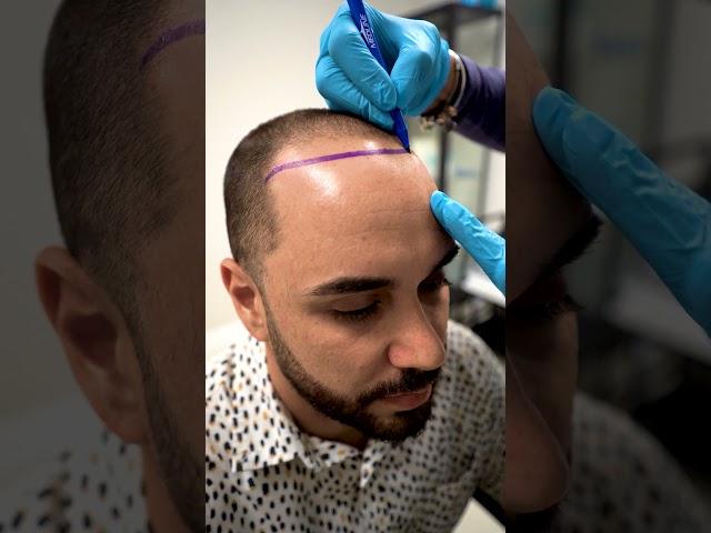 Hair Transplant in Care4Hair , Miami , Florida