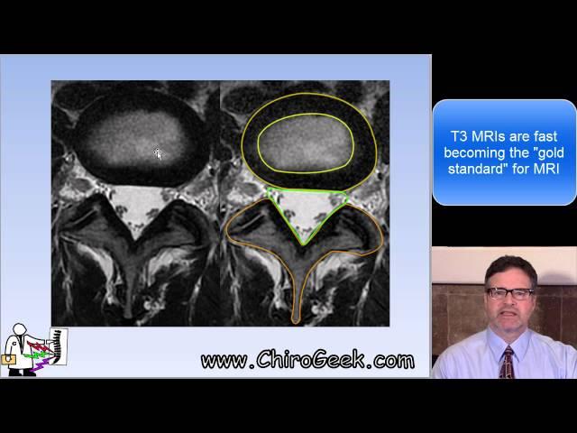 Dr. Gillard Lectures on Lumbar Disc Herniation / Protrusion. Part I of II