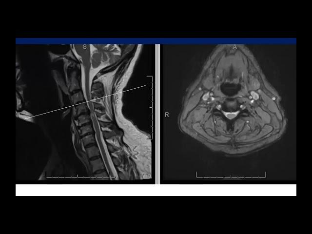 C5 Palsy After C4-C7 ACDF