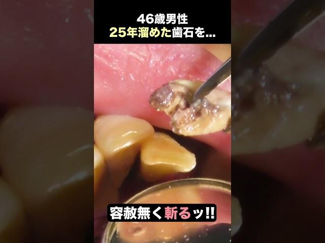 【仁義なき歯石除去】25年溜めた歯石を成敗します #歯医者 #ザホワイトデンタルクリニック #歯石除去