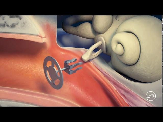 Kurz Passive Middle Ear Implants - Tympanoplasty Clip® Partial Prosthesis Dresden Type