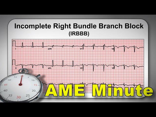 AME Minute: Why is an Incomplete Right Bundle Branch Block considered a normal variant?