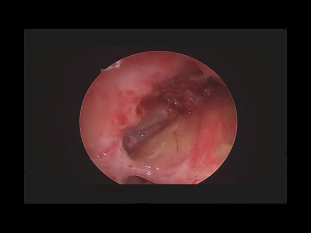 post operative endoscopic view of sinuses