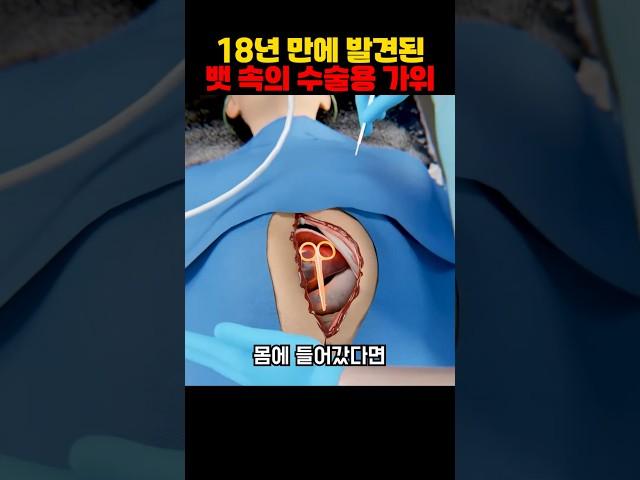 18년 만에 발견된 뱃 속의 수술용 가위
