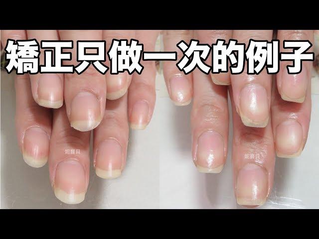 Example of problem nail correction only once / Correcting nails - Do a gel can solve the problem