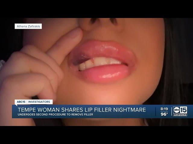 ‘The bruising is crazy’: Arizona woman shares lip filler nightmare