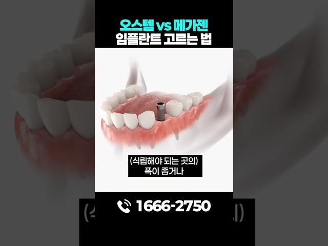 오스템vs메가젠, 임플란트 종류 별 차이점