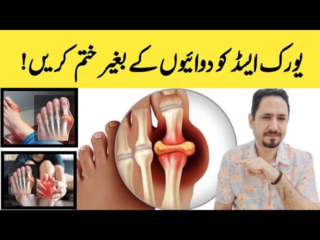 Control Uric Acid, Joint Pain & Swelling (Gout) यूरिक एसिड का इलाज - Dr Irfan Azeem