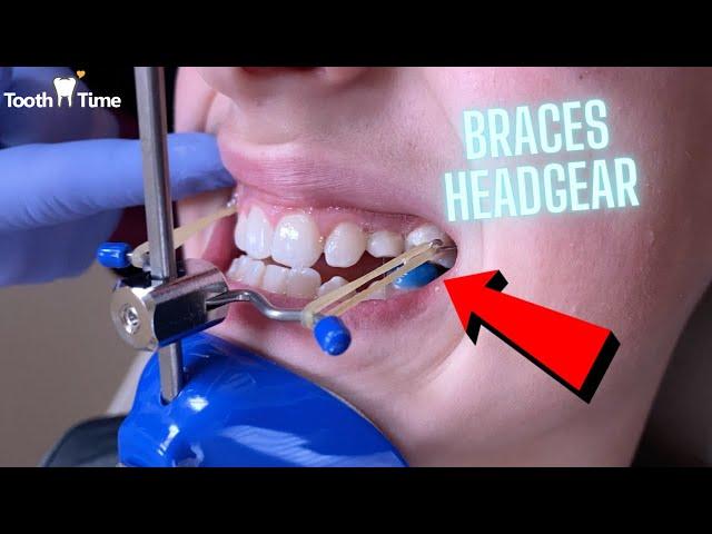 Headgear Braces - Orthodontic Appliance - 11 Year old patient - Tooth Time New Braunfels Texas