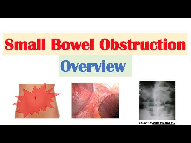 Small Bowel Obstruction (SBO) | Risk Factors, Causes, Signs & Symptoms, Diagnosis, Treatment