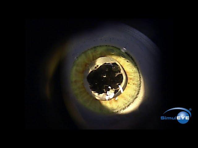 SimulEYE YAG Capsulotomy