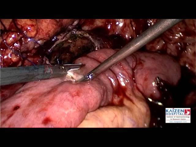 LAPAROSCOPIC CYSTOJEJUNOSTOMY - KAIZEN HOSPITAL AHMEDABAD