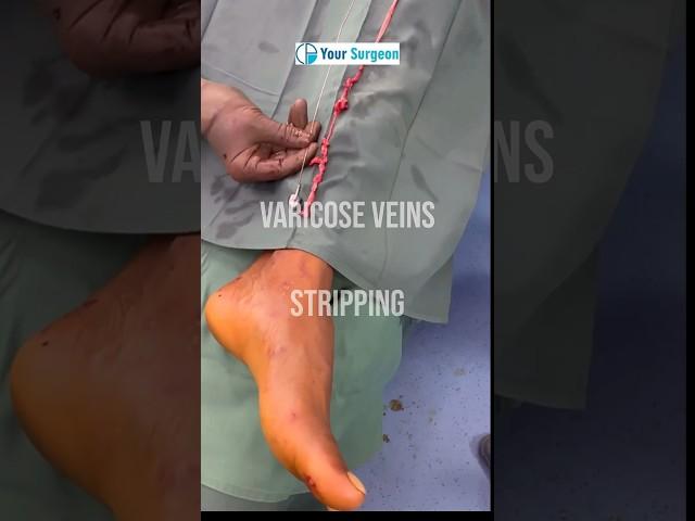 Recurrent Varicose veins ulcer treatment in Surat