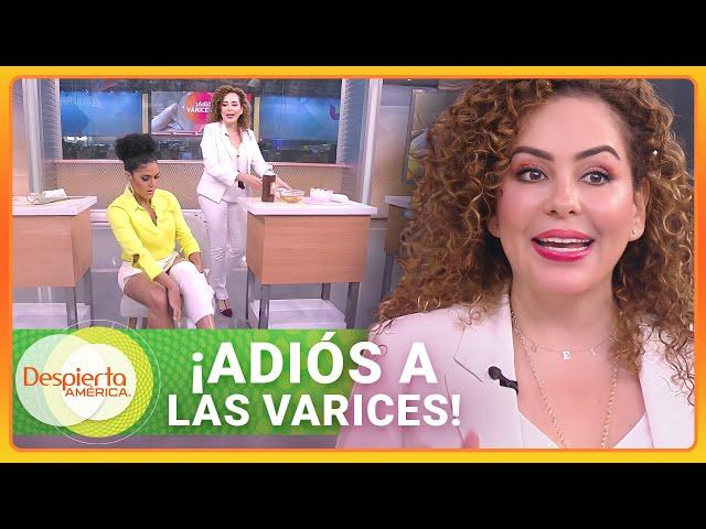 Remedios caseros para aliviar las molestias de las varices | Despierta América