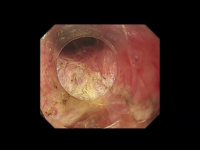 POEM for achalasia with marked esophageal varices