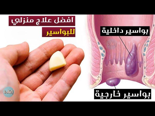 علاج البواسير بالثوم