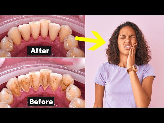 Deep Teeth Cleaning Recovery Tips (How To Heal Fast)