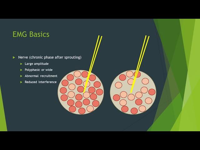 Neuropathy vs myopathy on EMG