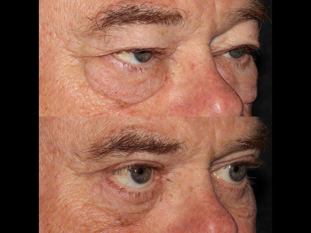 Cosmetic Upper Eye Lid Surgery