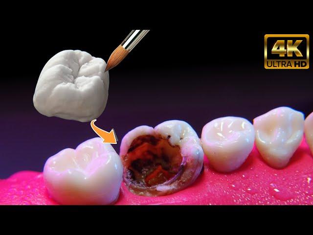 Extreme dental restoration!