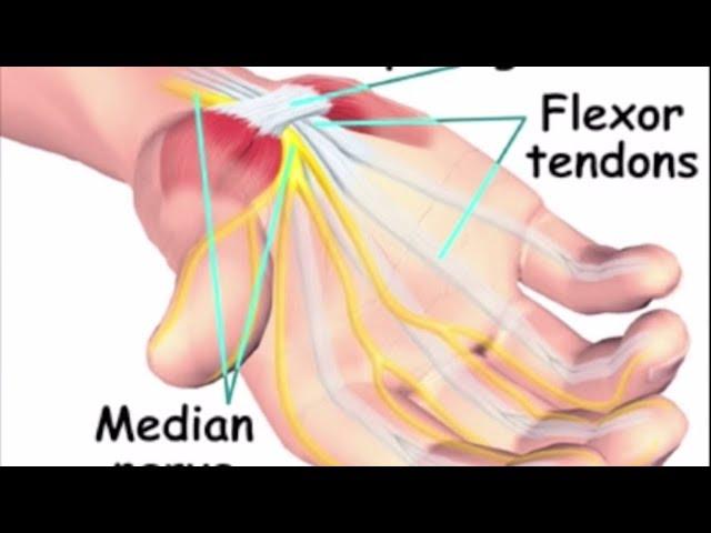 Airrosti Treatment: Carpal Tunnel Syndrome