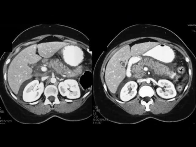 Evaluating Acute and Chronic Pancreatitis Part 1