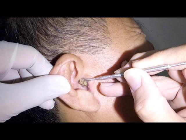 Huge Earwax Removed from GrandPa's Ear