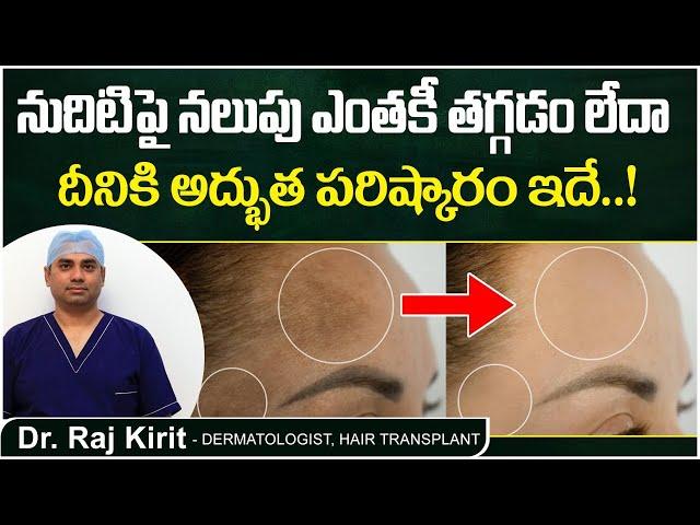 నుదిటిపై నలుపుకు పరిష్కారం | Forehead Pigmentation Telugu | Celestee Skin And Hair Clinic