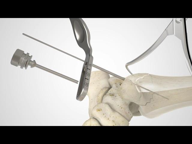 4.0 mm Cannulated Screw Surgical Technique Overview Animation